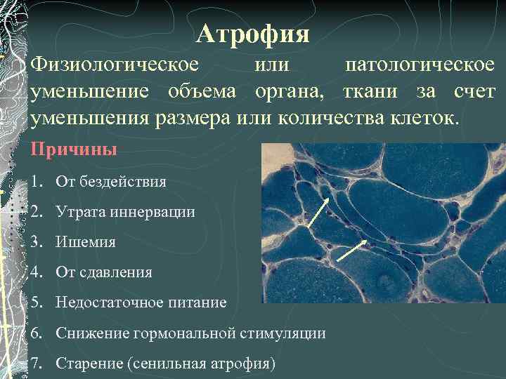 Атрофия Физиологическое или патологическое уменьшение объема органа, ткани за счет уменьшения размера или количества