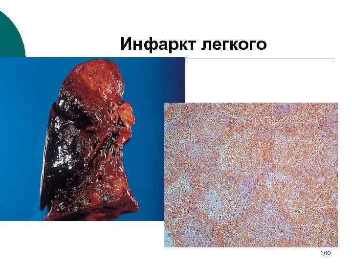 Инфаркт легкого 100 