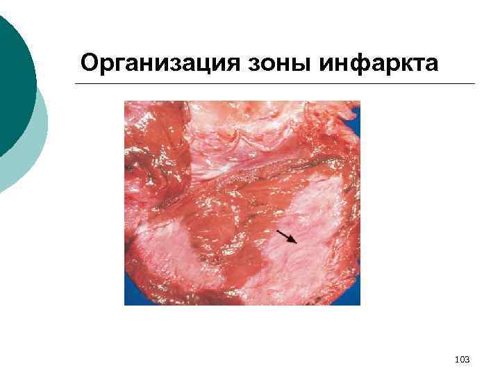 Организация зоны инфаркта 103 