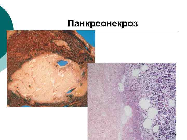 Панкреонекроз 105 