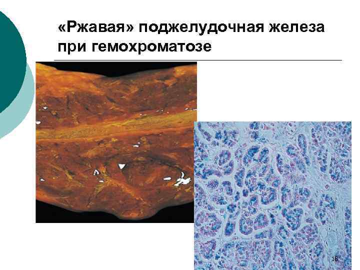  «Ржавая» поджелудочная железа при гемохроматозе 18 