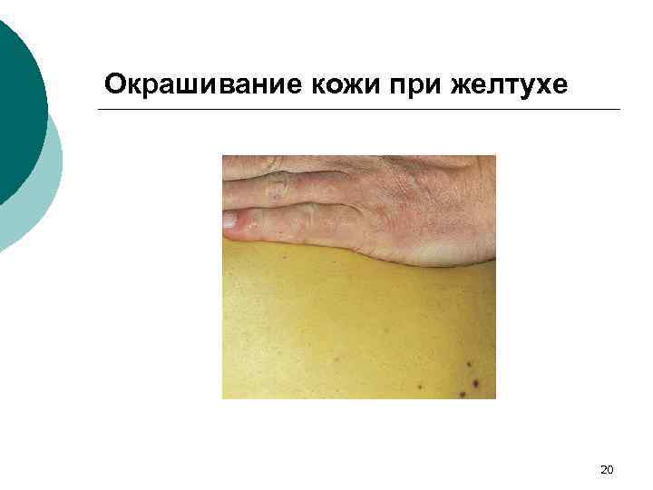 Окрашивание кожи при желтухе 20 