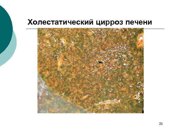 Холестатический цирроз печени 23 