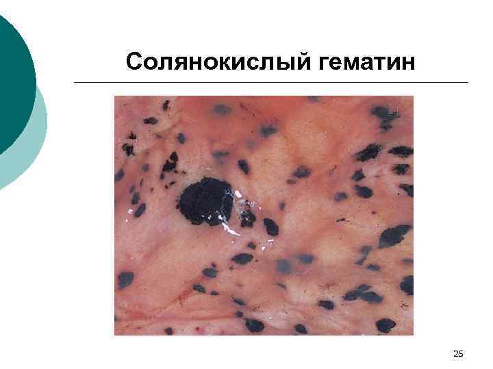 Солянокислый гематин 25 