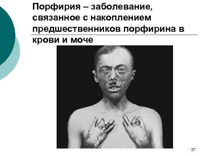 Порфирия – заболевание, связанное с накоплением предшественников порфирина в крови и моче 27 
