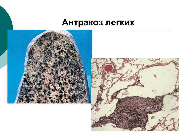 Силикоз легкого микропрепарат рисунок