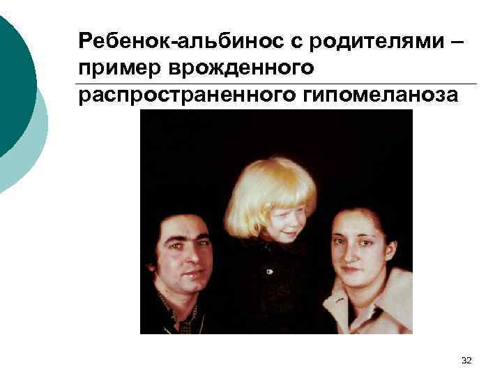 Ребенок-альбинос с родителями – пример врожденного распространенного гипомеланоза 32 