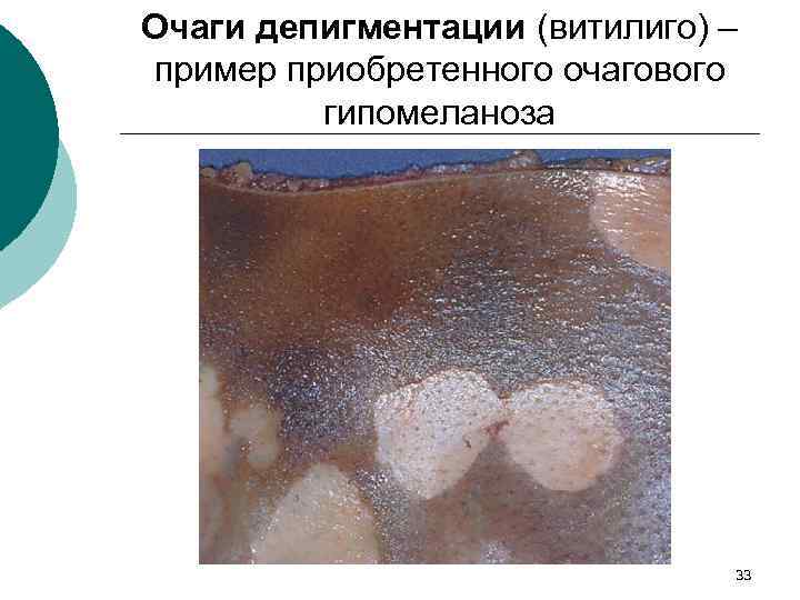 Очаги депигментации (витилиго) – пример приобретенного очагового гипомеланоза 33 