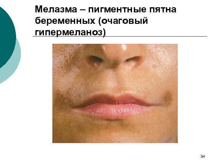 Мелазма – пигментные пятна беременных (очаговый гипермеланоз) 34 