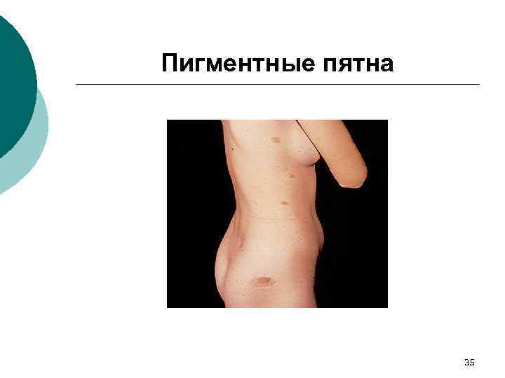 Пигментные пятна 35 