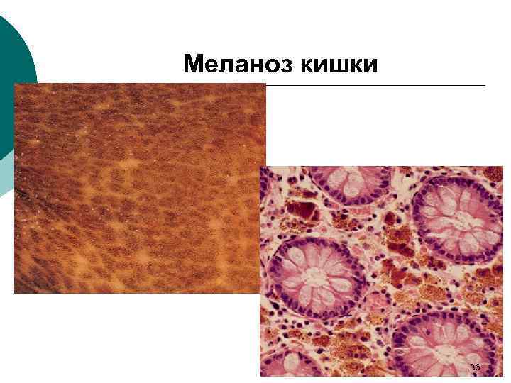 Меланоз кишки 36 