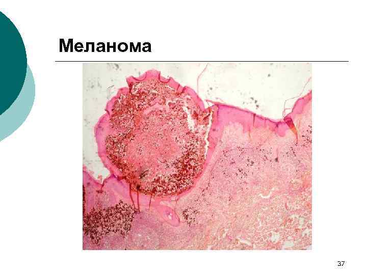 Меланома 37 