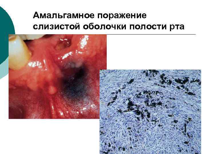 Амальгамное поражение слизистой оболочки полости рта 4 