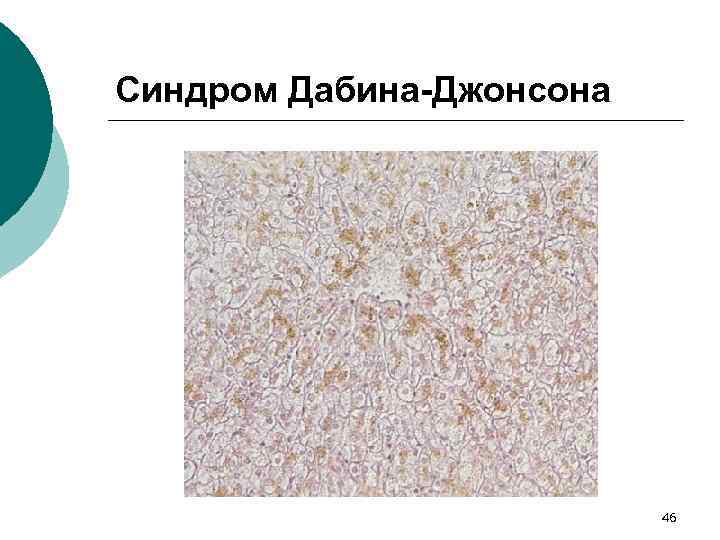 Синдром Дабина-Джонсона 46 