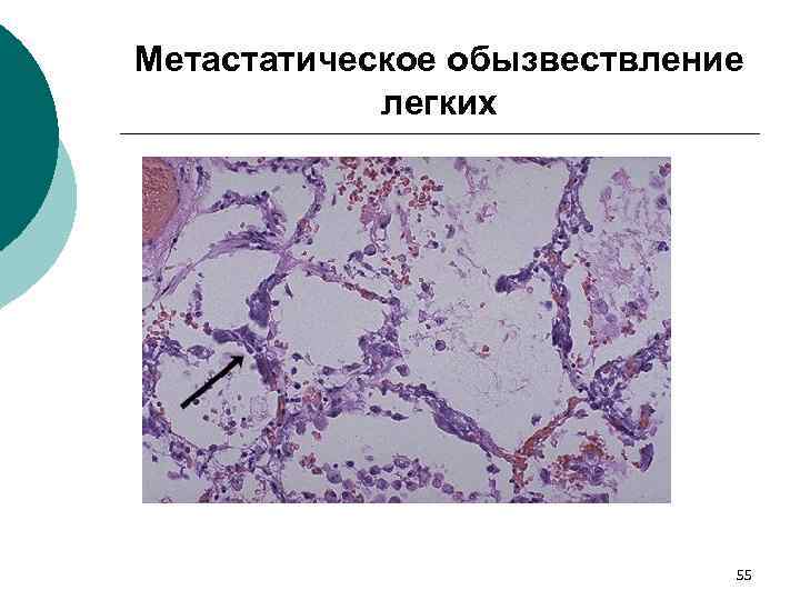 Метастатическое обызвествление легких 55 