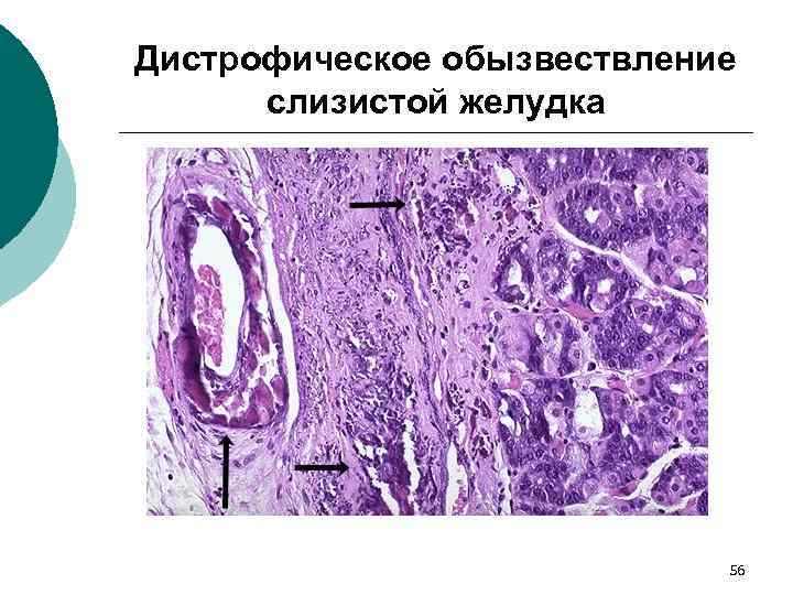 Дистрофическое обызвествление слизистой желудка 56 