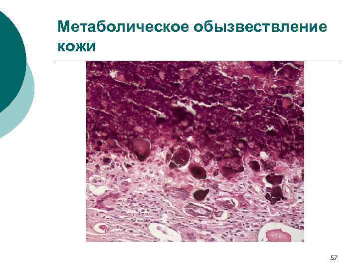 Метаболическое обызвествление кожи 57 