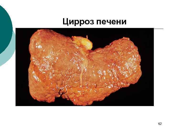 Цирроз печени 62 