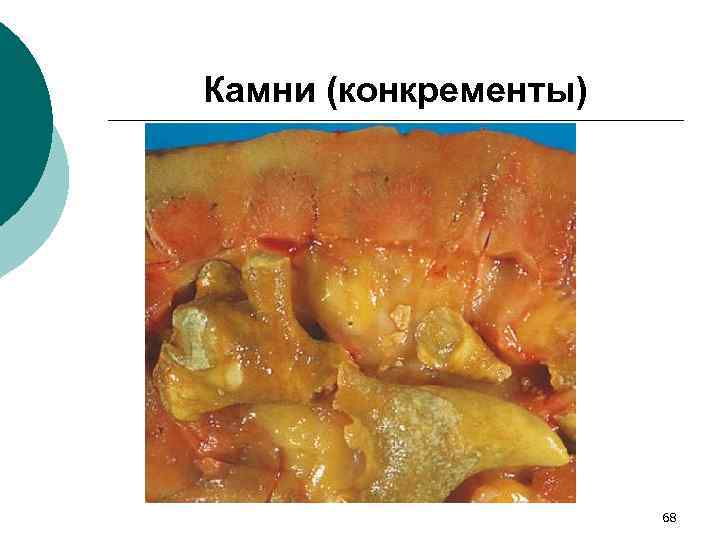 Камни (конкременты) 68 