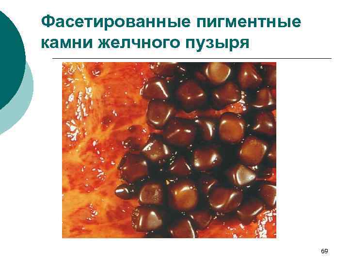 Фасетированные пигментные камни желчного пузыря 69 