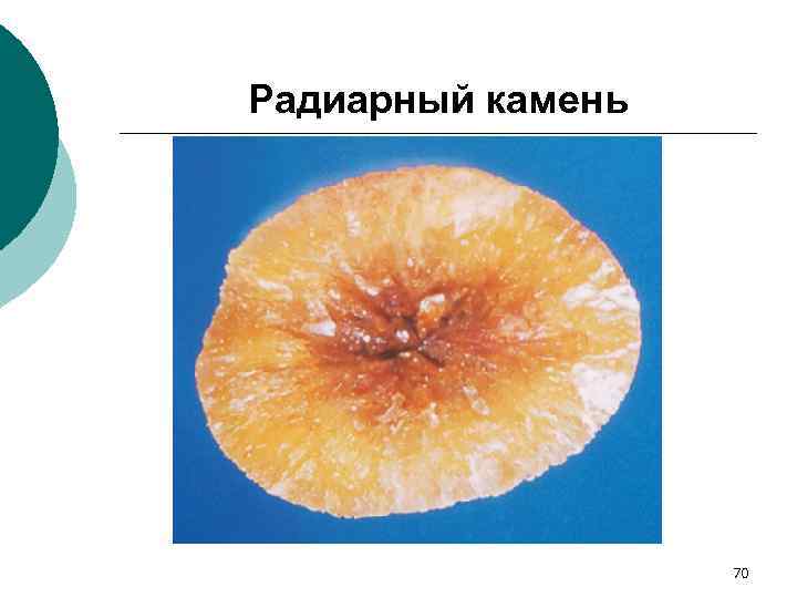 Радиарный камень 70 