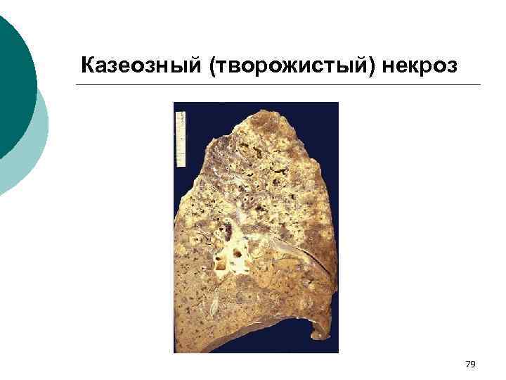 Казеозный (творожистый) некроз 79 