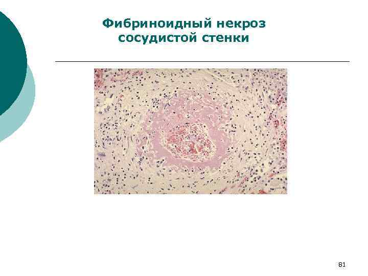 Фибриноидное набухание это. Коагуляционный фибриноидный некроз. Фибриноидный некроз сосудистой стенки. Фибриноидный некроз стенок сосудов микропрепарат. Фибриноидный некроз микропрепарат.