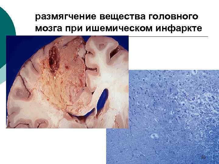 размягчение вещества головного мозга при ишемическом инфаркте 83 