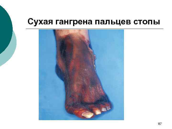 Сухая гангрена пальцев стопы 87 