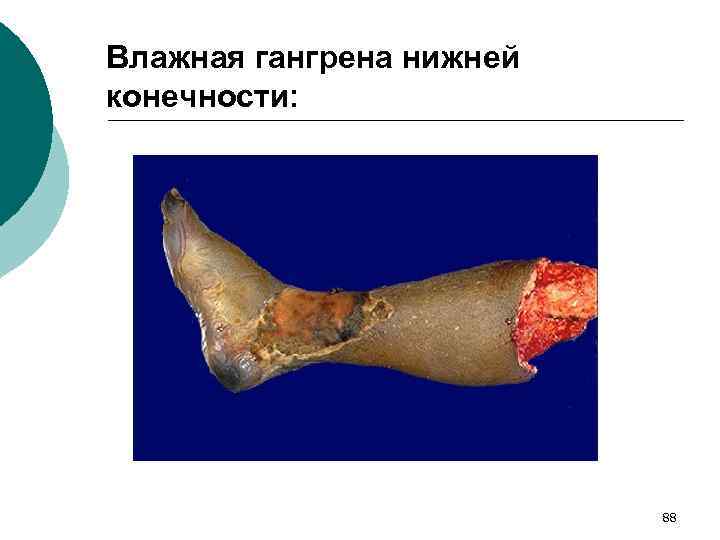 Влажная гангрена нижней конечности: 88 