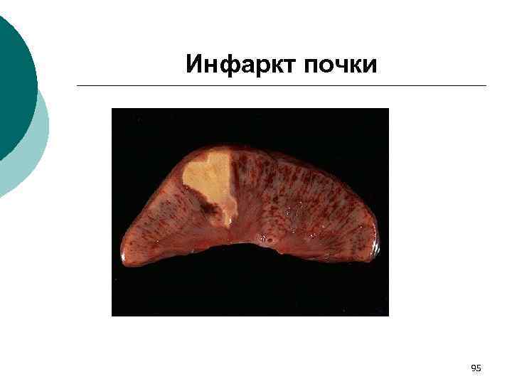Инфаркт почки 95 
