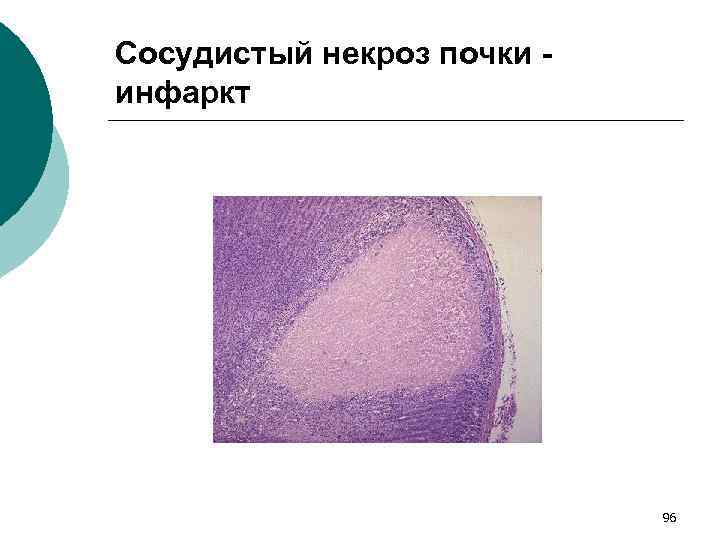 Сосудистый некроз почки инфаркт 96 