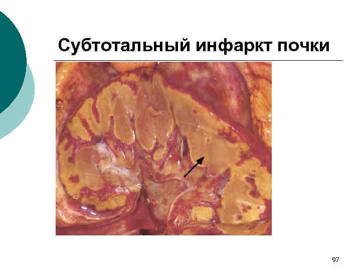 Субтотальный инфаркт почки 97 