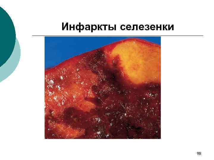 Инфаркты селезенки 98 