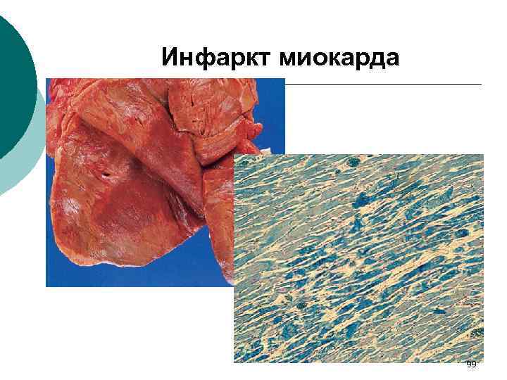 Инфаркт миокарда 99 