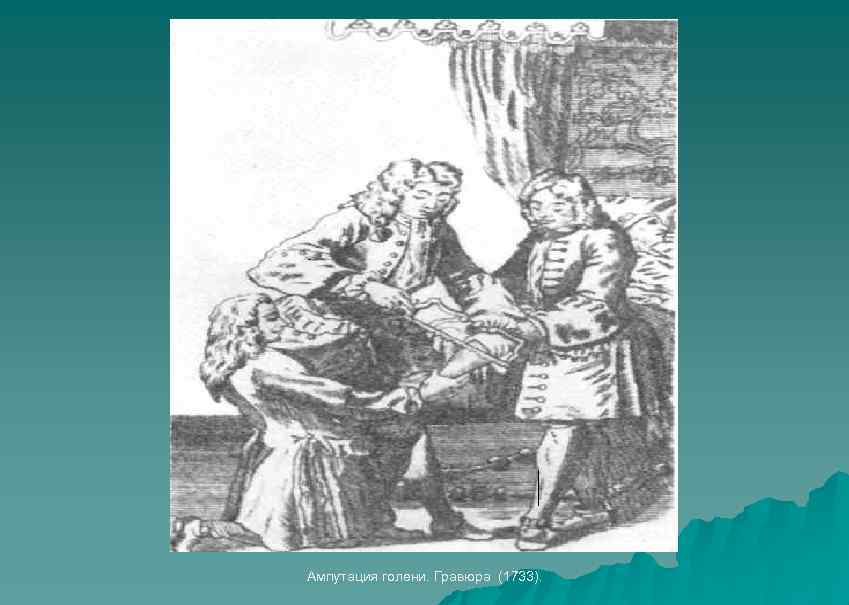 Ампутация голени. Гравюра (1733). 