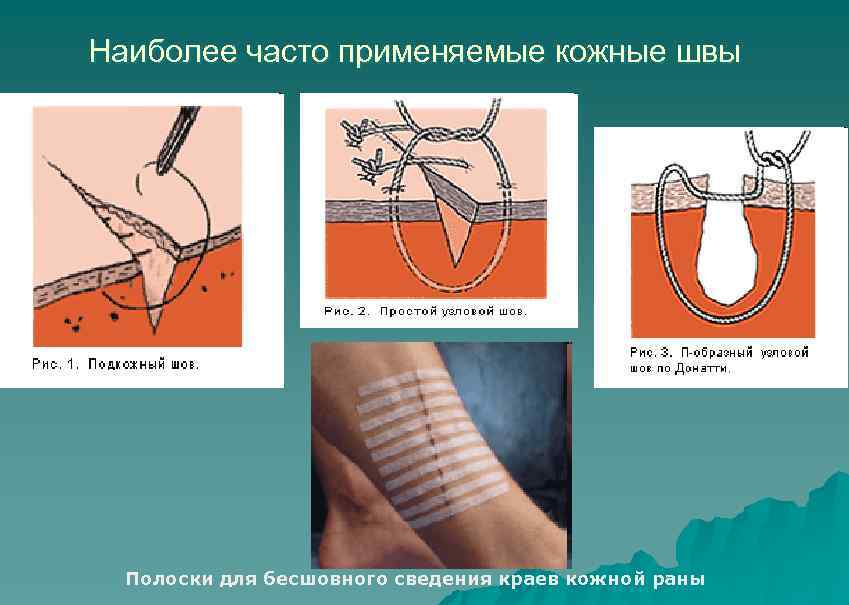 Наиболее часто применяемые кожные швы Полоски для бесшовного сведения краев кожной раны 