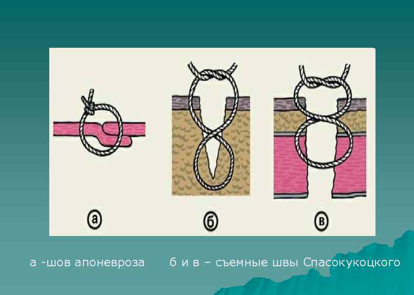 а -шов апоневроза б и в – съемные швы Спасокукоцкого 
