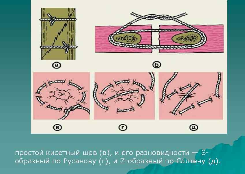 простой кисетный шов (в), и его разновидности — Sобразный по Русанову (г), и Z-образный