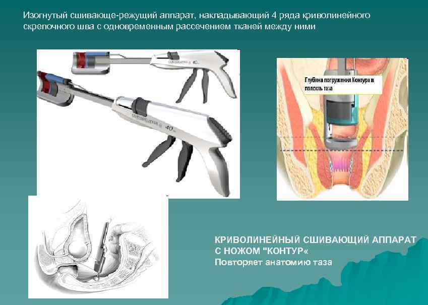 Изогнутый сшивающе-режущий аппарат, накладывающий 4 ряда криволинейного скрепочного шва с одновременным рассечением тканей между