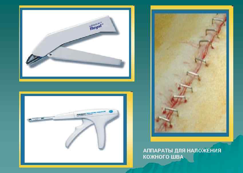 АППАРАТЫ ДЛЯ НАЛОЖЕНИЯ КОЖНОГО ШВА 