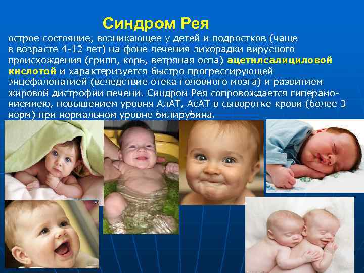  Синдром Рея острое состояние, возникающее у детей и подростков (чаще в возрасте 4