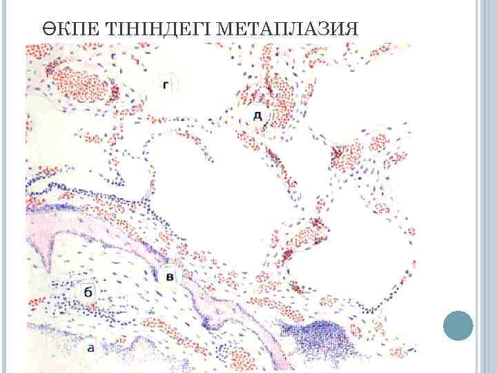 ӨКПЕ ТІНІНДЕГІ МЕТАПЛАЗИЯ 