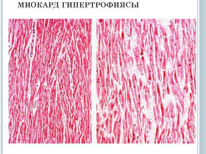 Гипертрофия миокарда. Гипертрофия миокарда микропрепарат. Гипертрофия миокарда гистология. Регенерационная гипертрофия миокарда микропрепарат. Гипертрофия миокарда микроскопия.