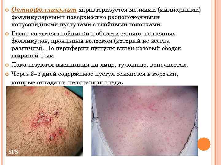  Остиофолликулит характеризуется мелкими (милиарными) фолликулярными поверхностно расположенными конусовидными пустулами с гнойными головками. Располагаются