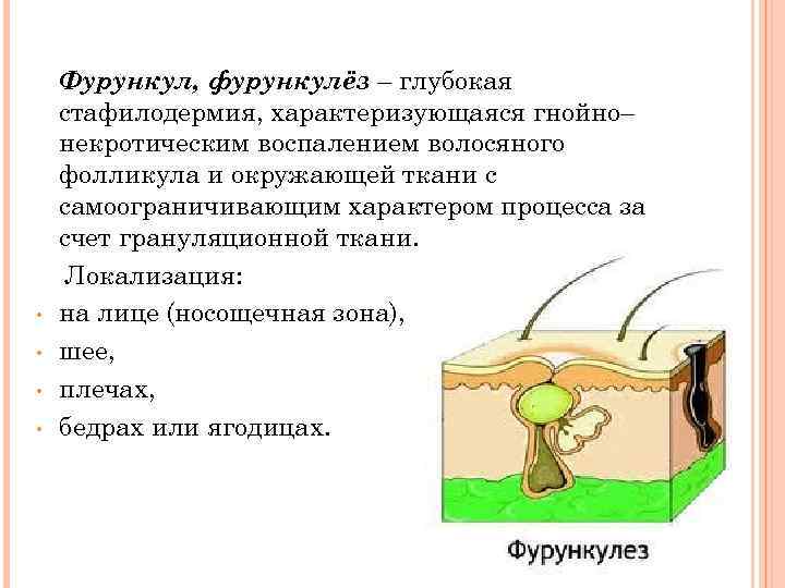  • • Фурункул, фурункулёз – глубокая стафилодермия, характеризующаяся гнойно– некротическим воспалением волосяного фолликула