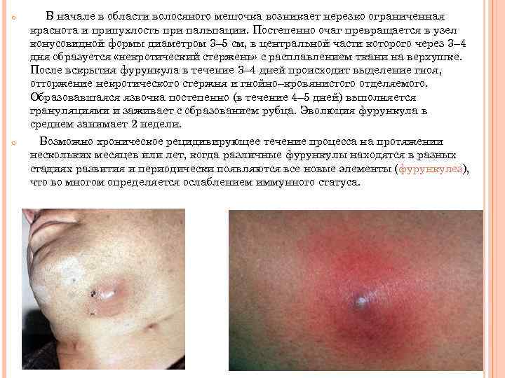 o o В начале в области волосяного мешочка возникает нерезко ограниченная краснота и припухлость