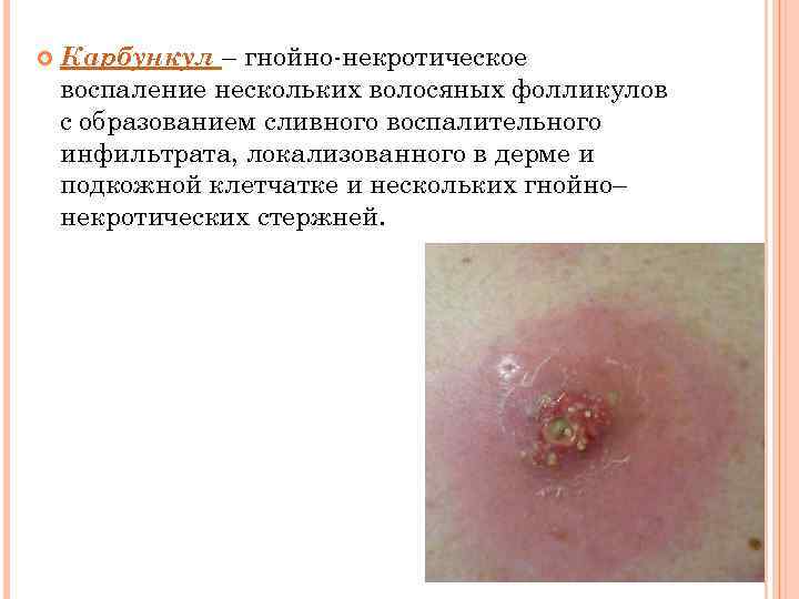  Карбункул – гнойно-некротическое воспаление нескольких волосяных фолликулов с образованием сливного воспалительного инфильтрата, локализованного