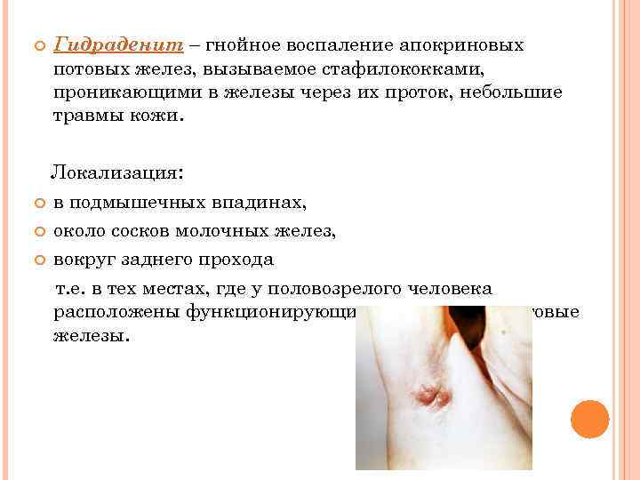  Гидраденит – гнойное воспаление апокриновых потовых желез, вызываемое стафилококками, проникающими в железы через