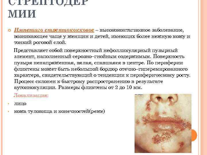 СТРЕПТОДЕР МИИ Импетиго стрептококковое – высококонтагиозное заболевание, возникающее чаще у женщин и детей, имеющих